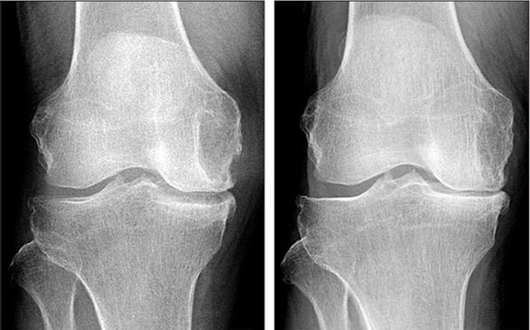 Antes y después del tratamiento de la artrosis con Hondrofrost. 