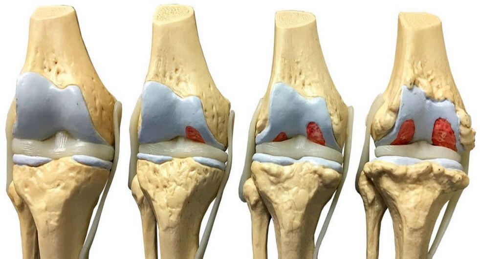 Osteoartritis que debe tratarse con Hondrofrost