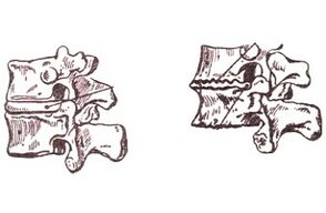 Etapas de desarrollo de la tóraxosteocondrosis