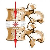 El dispositivo de la columna y las causas de la osteocondrosis