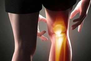 Destrucción de la articulación de la rodilla como resultado de la osteoartritis.