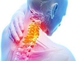 Dolor y punzadas en la zona del cuello en osteocondrosis de tercer grado.