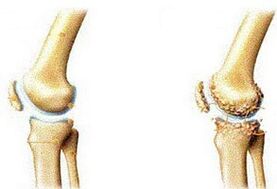 artrosis articular y articular sana