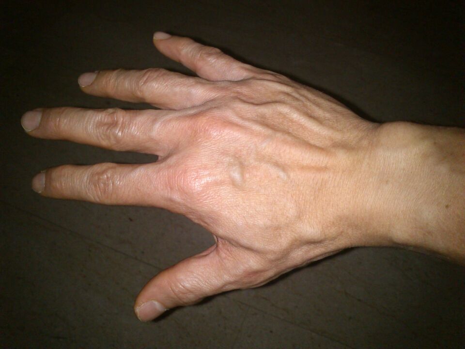 Deformación ósea y dolor en las articulaciones de los dedos.