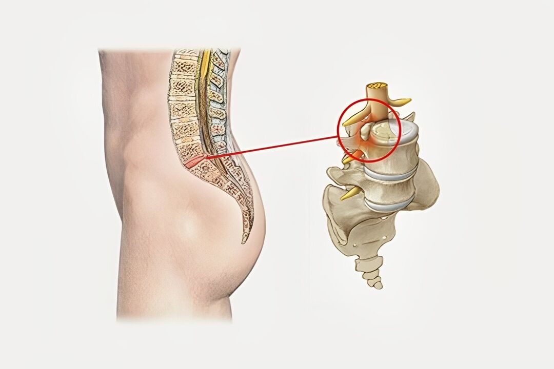 Deformación del disco intervertebral en la columna sacra. 