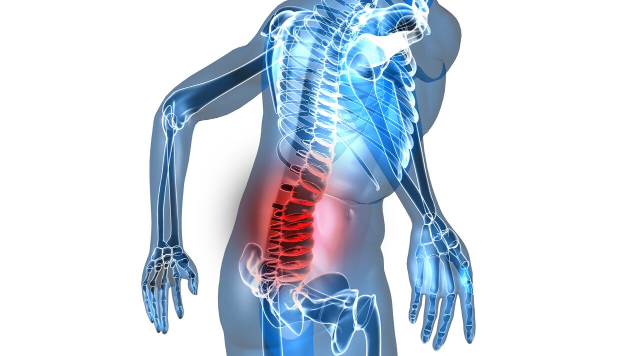 Osteocondrosis de la columna lumbar. 